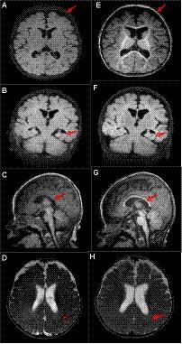 Synonymous variants in the ATP6AP2 gene may lead to developmental and epileptic encephalopathy